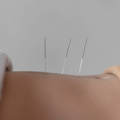 Agulhas de Acupuntura - Ferramentas Terapêuticas para Tratamentos de Saúde e Bem-Estar